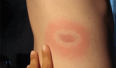 Lyme Disease